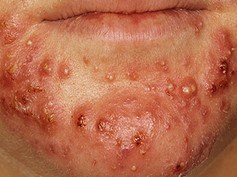 A chin with severe acne