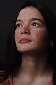 A girl with acne on her face