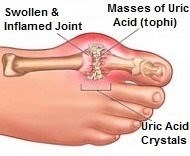 A diagram of an affected toe joint caused by gout