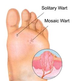 Warts and verrucae on feet