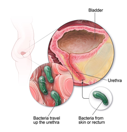 Diagram of a urinary tract infection (UTI)