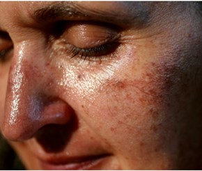 A woman's face with age spots