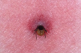 A tick embedded within skin