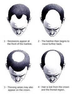 Male Pattern Baldness